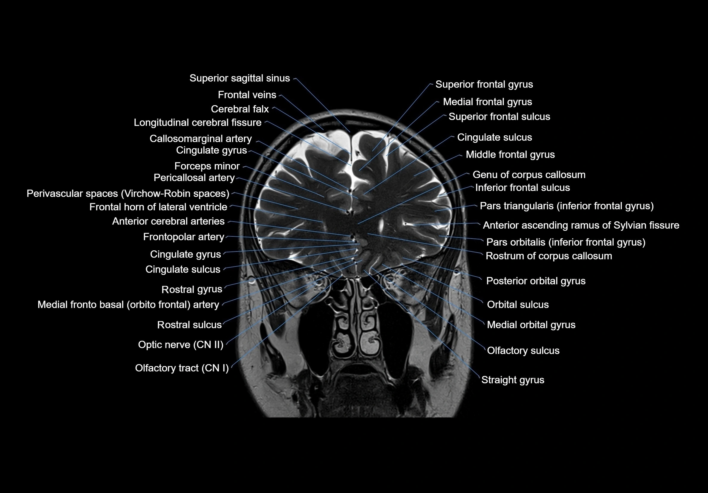 MRI Brain coronal cross sectional labelled anatomy 3T image  -img-00001-00021.webp